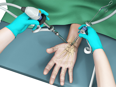 Wrist Arthroscopy - Educational Picture