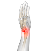 Wrist Dislocation Image