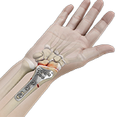 Wrist Fracture Fixation Image
