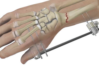 Wrist Fracture Fixation - Educational Picture
