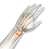 Wrist Fracture Image