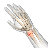 Wrist Fracture Treatment Image
