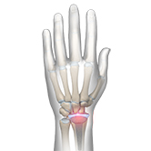 Wrist Joint Replacement Image