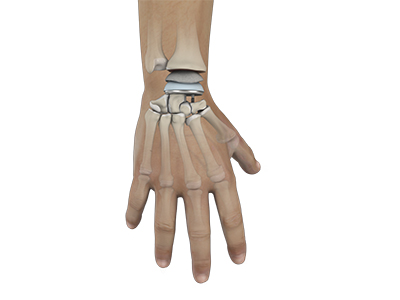 Wrist Joint Replacement - Educational Picture