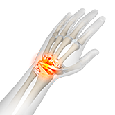 Wrist Ligament Reconstruction Image
