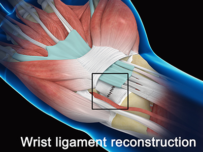 Wrist Ligament Reconstruction - Educational Picture
