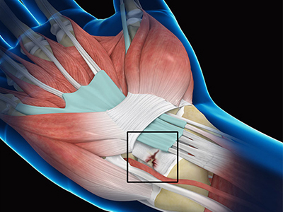 Wrist Ligament Tear and Instability - Educational Picture