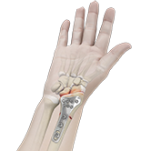 Wrist Open Reduction and Internal Fixation Image