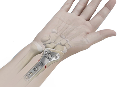 Wrist Open Reduction and Internal Fixation - Educational Picture