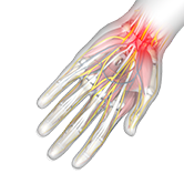 Wrist Pain Image