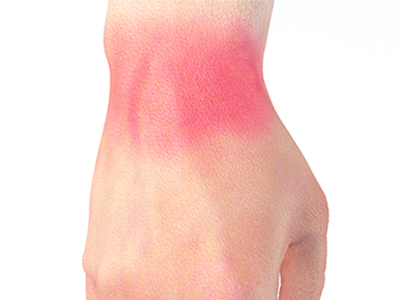 Wrist Sprains - Educational Picture