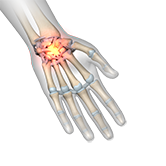 Wrist Sprains Image